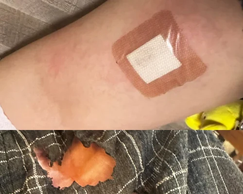 Seventeenコン「花火」事故、被害ファン火傷写真UP…服に穴も